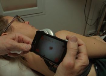 Anapix (Meyreuil) facilite le dépistage du mélanome