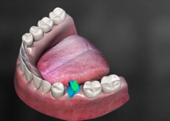 Biotech Dental lève 52 millions d'euros auprès de Sofina