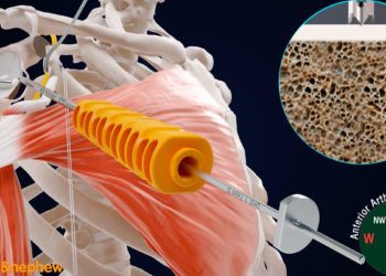 Une nouvelle intervention, la butée* (ou « Latarjet ») d’épaule par arthroscopie (exploration de l'intérieur d'une articulation à l'aide d'un tube appelé endoscope) est désormais pratiquée à la Polyclinique du Parc Rambot.