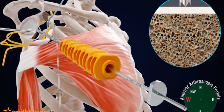 Une nouvelle intervention, la butée* (ou « Latarjet ») d’épaule par arthroscopie (exploration de l'intérieur d'une articulation à l'aide d'un tube appelé endoscope) est désormais pratiquée à la Polyclinique du Parc Rambot.
